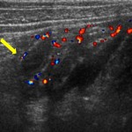 Ultrasound Diagnoses Appendicitis Without X-Rays