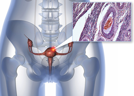 Genes Behind Aggressive Endometrial Cancer