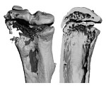 Emerging Cancer Drugs May Drive Bone Tumors