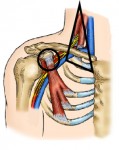 Treat Nerve Compression Disorder