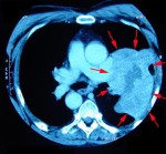 Lungs for Spread of Cancer